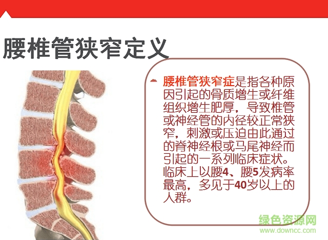 腰椎管狹窄護理查房ppt 免費版 0